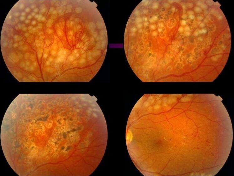 Hypertensive Retinopathie